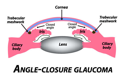 Angle-closure Glaucoma